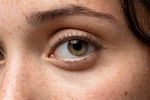 Macular Degeneration: Symptoms, Causes, Treatment, and How to Protect Your Vision